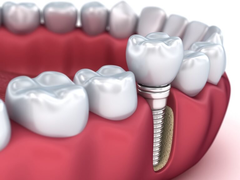 7 Benefits of Dental Implants Over Bridges and Dentures